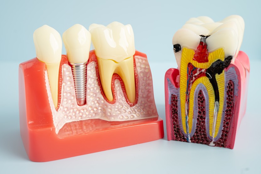 tooth implant costs