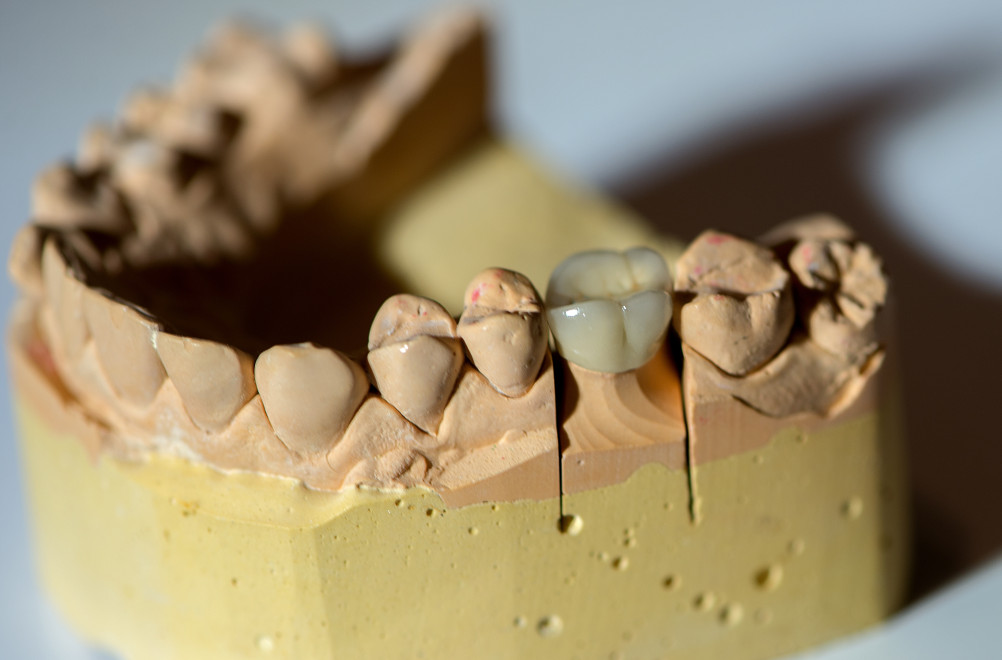 Dental Crowns in Mississauga