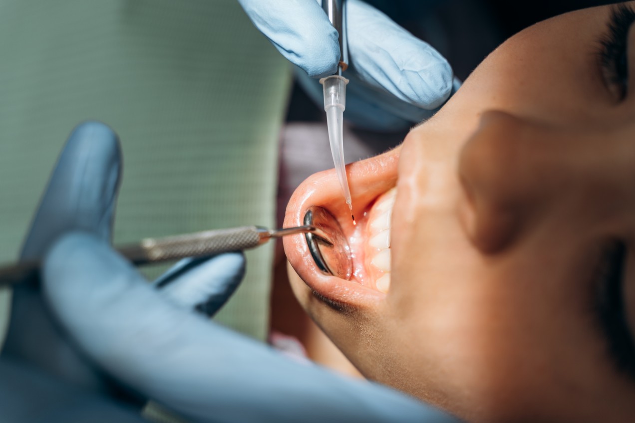 Tooth Extraction Services